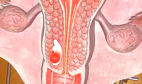 Дисплазия влагалища и шейки матки